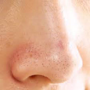 Blackhead1