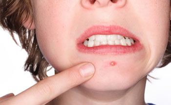 Everything You Need To Know About Acne