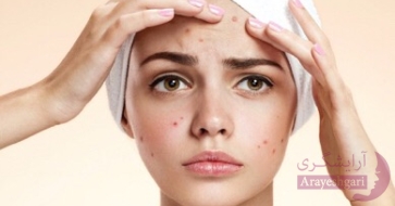 از بین بردن جوش و جای جوش با جوش شیرین